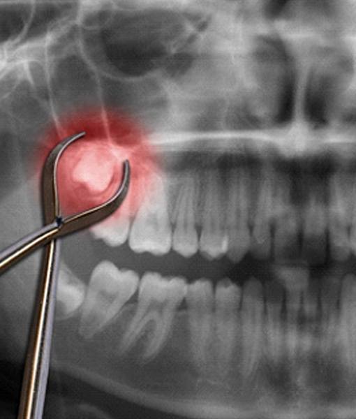 X-ray showing wisdom tooth before tooth extractions Edmonton