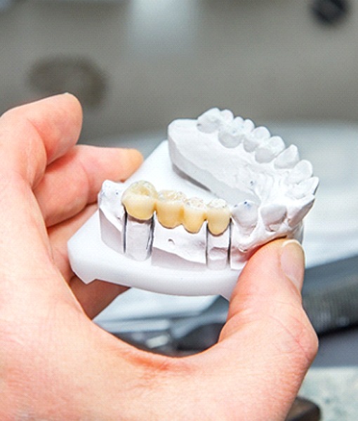 Dental bridge in Edmonton on clay model