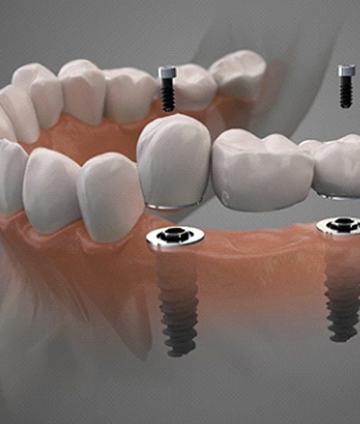 Digital illustration of dental bridge in Edmonton