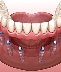 Illustration of implant denture supported by six dental implants