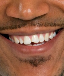 Closeup of smile with chipped front tooth