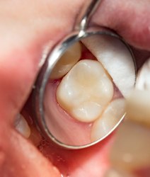 Closeup of smile after a lost dental crown is replaced