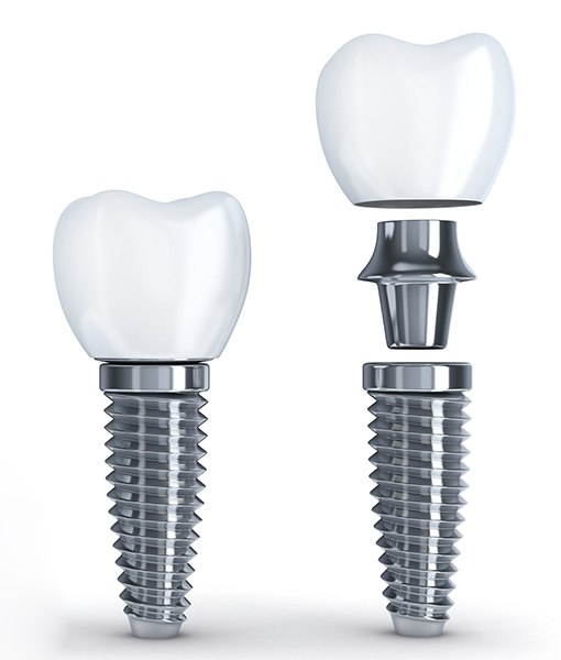 Two animated dental implant examples