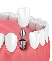 Animated dental implant supported dental crown placement