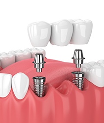 Animated dental implant supported fixed bridge placement