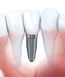 Illustration of a single dental implant in Edmonton, AB