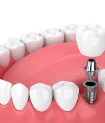 Illustration of crown, abutment, and dental implant in Edmonton, AB