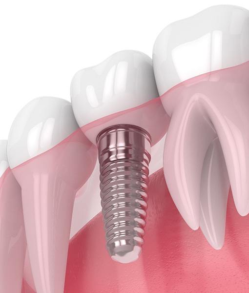 Dental implants in Edmonton