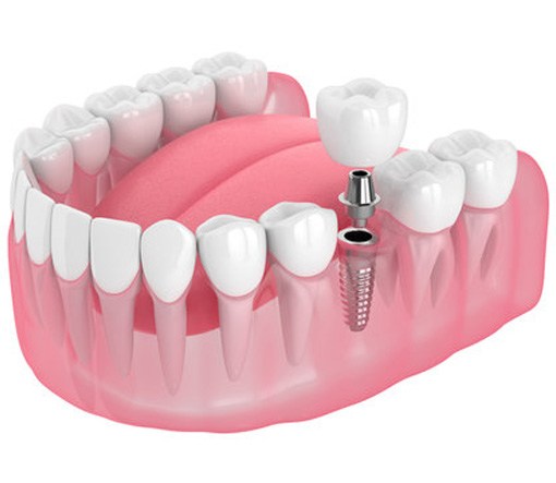 a diagram showing a dental implant being placed