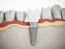 an illustration of a dental implant fusing with the jaw