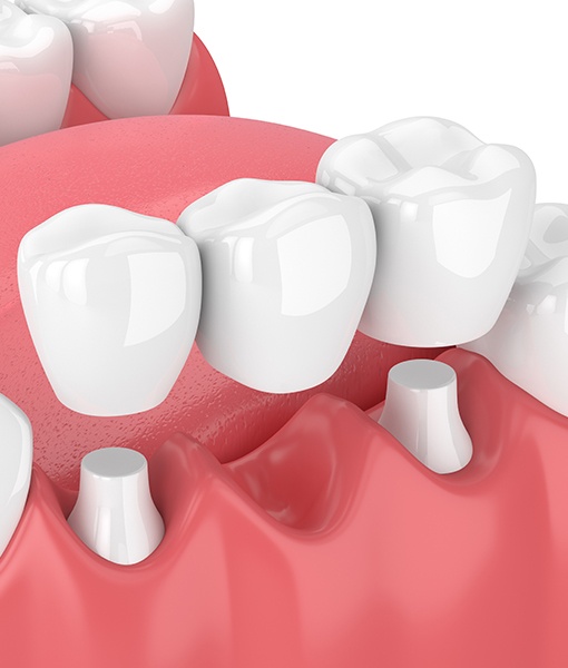 Animated smile during dental bridge placement