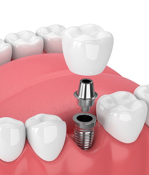 Animated dental implant supported dental crown placement