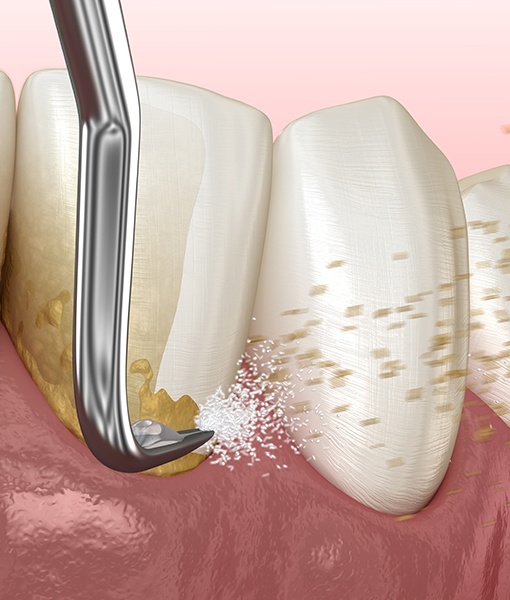 Animated smile during scaling and root planing treatment