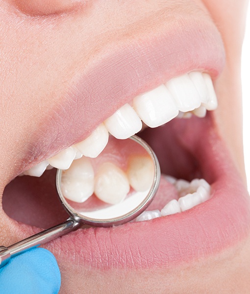 Dentist examining patient's smile after tooth colored filling treatment