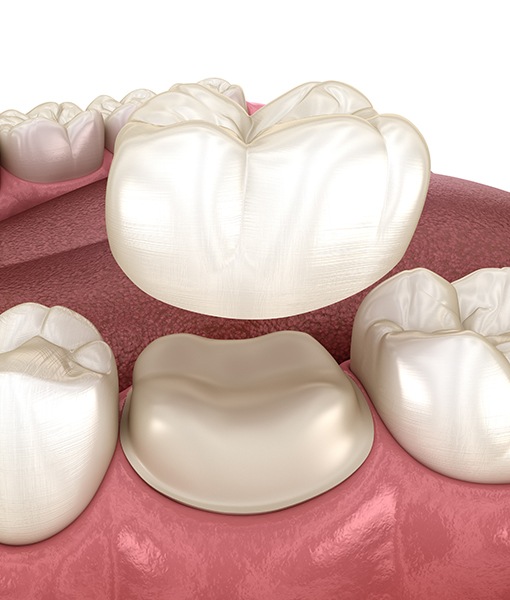 Animated smile during dental crown placement