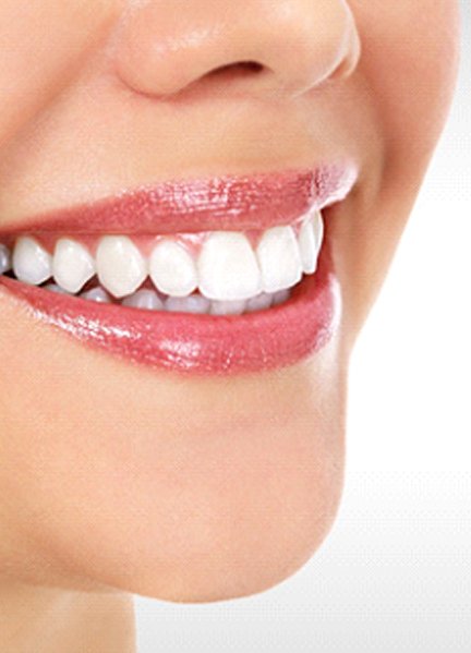 Close-up of beautiful smile with veneers in Edmonton