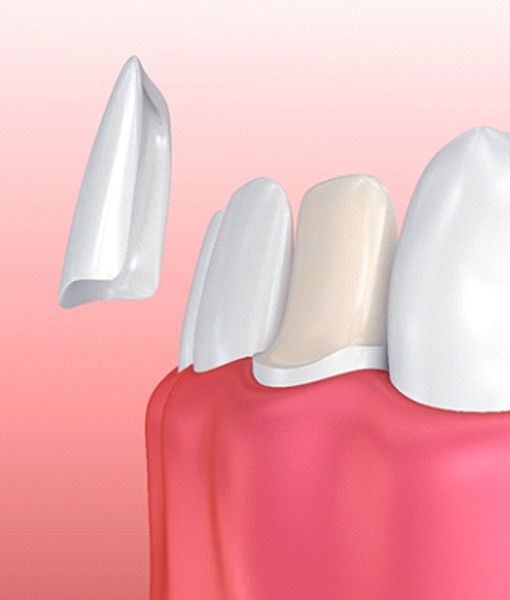 Illustration of dental veneer being placed on tooth