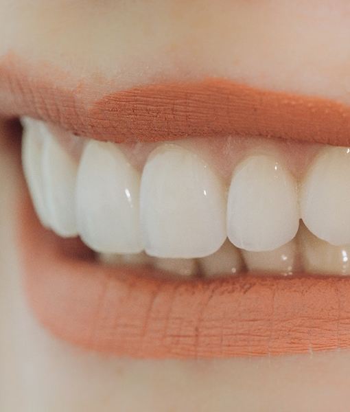 Closeup of woman smiling with veneers in Edmonton