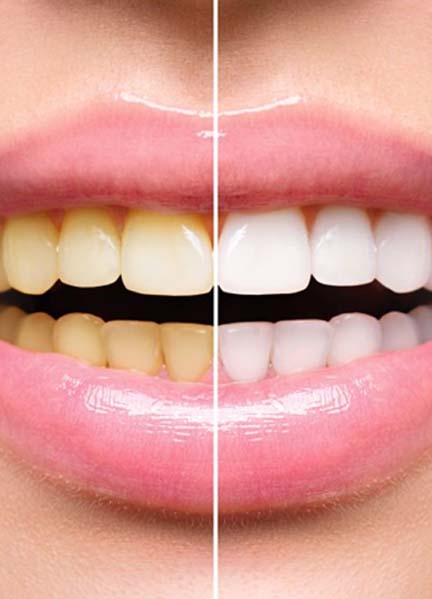 Closeup before and after teeth whitening in Edmonton 
