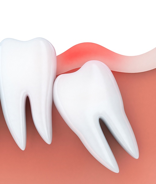 Animated smile with an impacted wisdom tooth